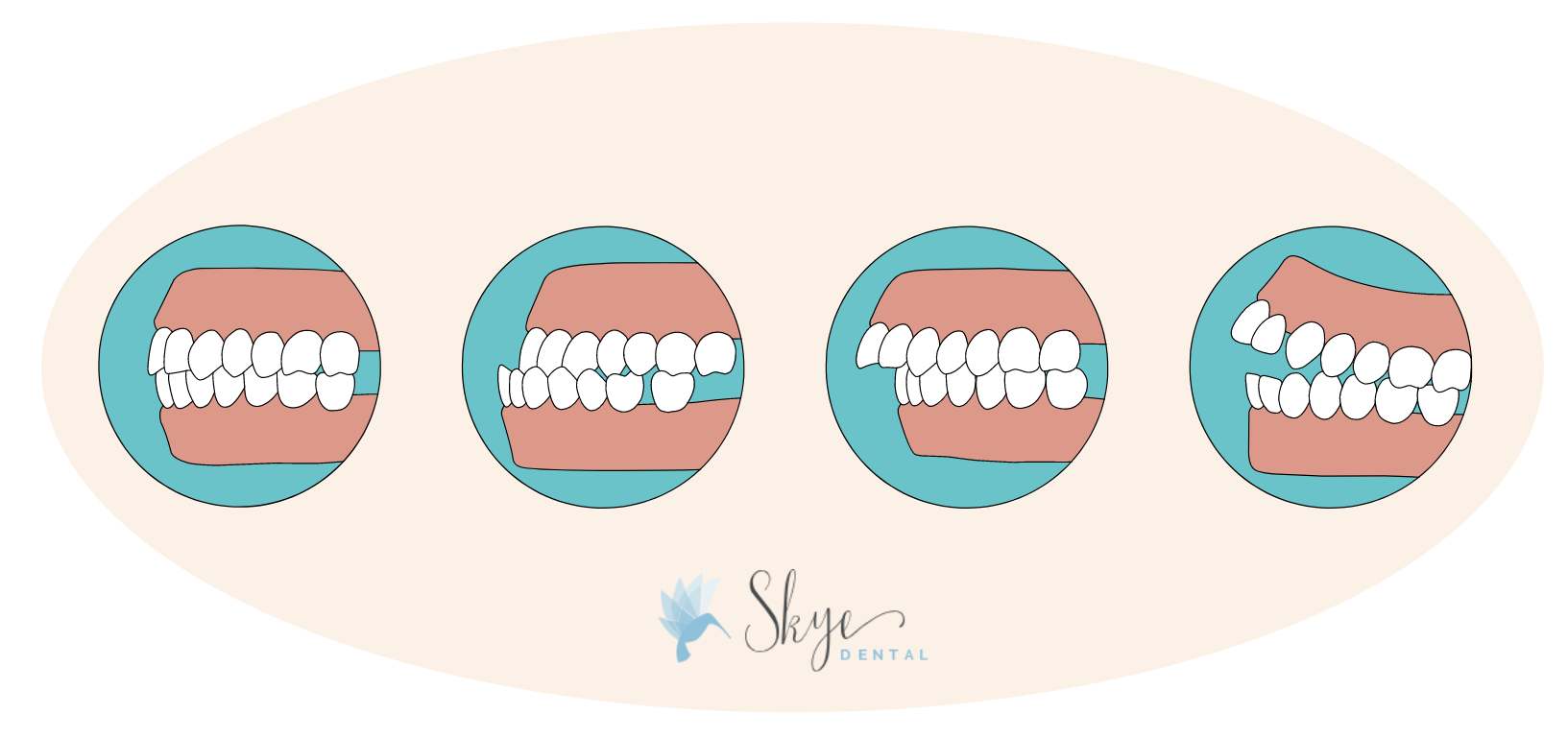 Bite Mechanics 101: Understanding Occlusion and Its Impact on Oral